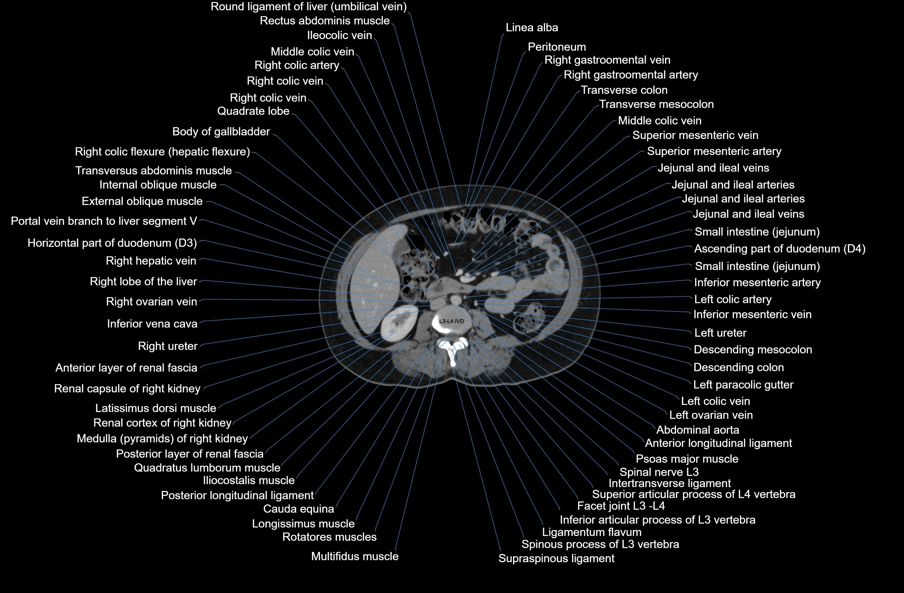 CT Abdomen axial cross sectional anatomy labelled radiology image-00046.webp